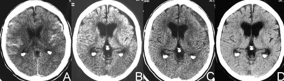 70 Arq Neuropsiquiatr 2007;65(1) Fig 3. Case 3. (A) CT scan on admission showing diffuse subarachnoid hemorrhage and small subdural effusion in the left frontal region (1 st day).