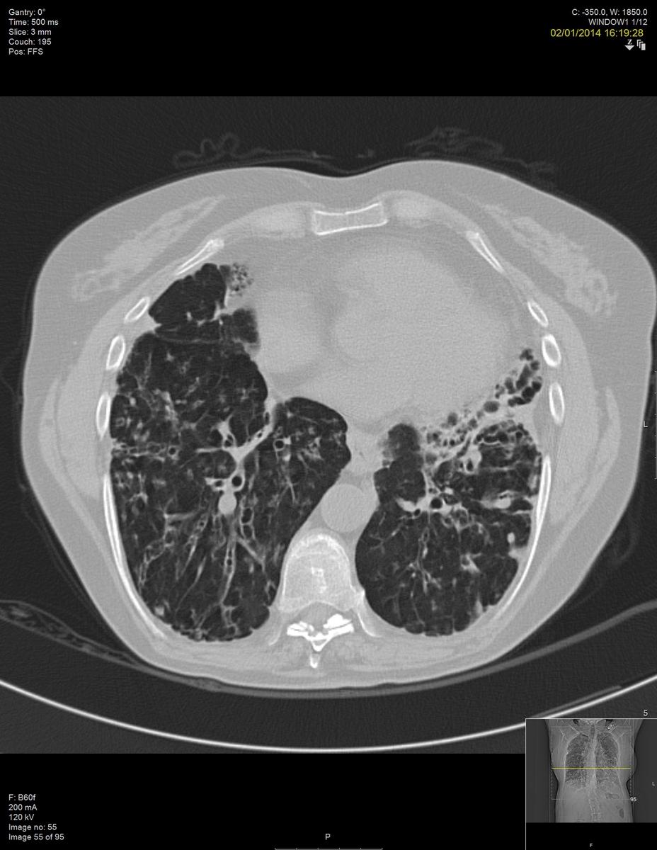 Fig. 2: HRCT Thorax of an immunologically confirmed CVID patient