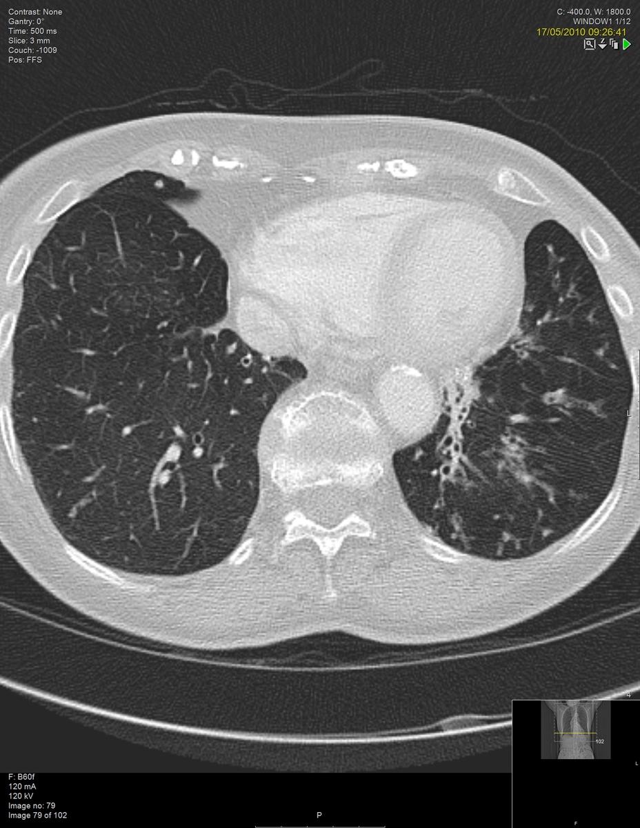 Fig. 4: HRCT Thorax of the same immunologically confirmed CVID