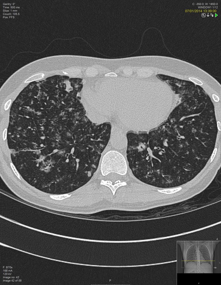 Fig. 6: HRCT Thorax of a case of GL-ILD displaying septal thickening and diffuse lung nodularity.