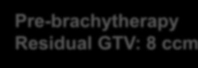 Example: cervical cancer IIIB: GTV shrinkage +