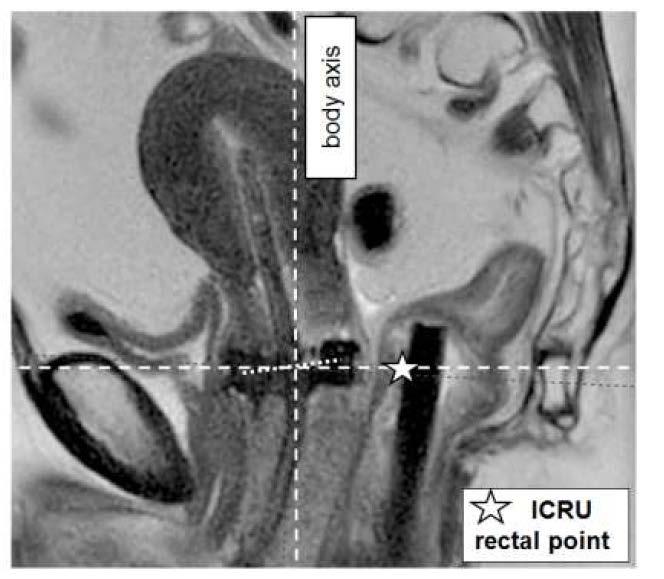 Dose effect relation Vaginal stenosis and ICRU recto-vaginal point (ICRU 89) N=630 multi-centre,
