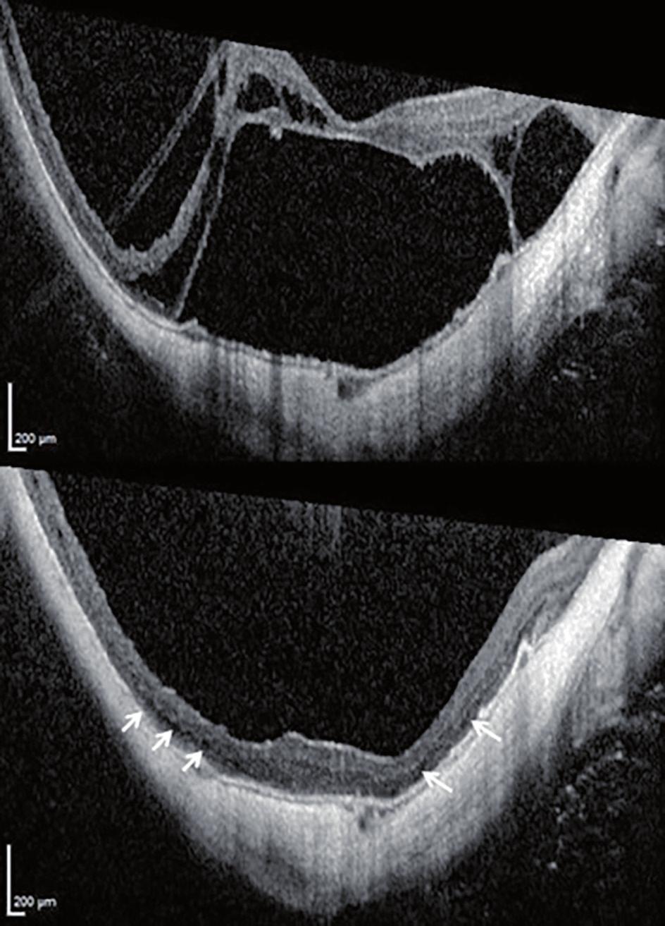 As an intraoperative complication, a peripheral retinal tear was observed and immediately surrounded with 3 rows of argon laser photocoagulation during vitrectomy.