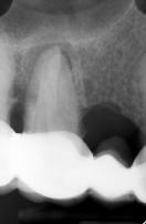 an access to the endodontic space and is a prerequisite for achieving maximum results in the next stages.