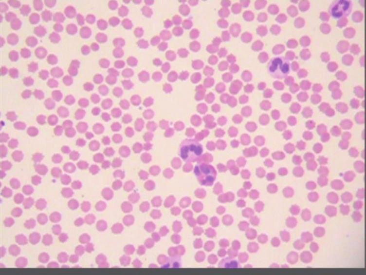 Collett s snake envenoming 113 Figure 3. Blood film from case 3 showing spherocytes and echinocytes. The haemolytic anaemia and thrombocytopenia resolved with no specific treatment.