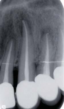In 60% of roots the gutt-perch ws FIGURE 2: Preopertive peripicl rdiogrph of tooth 23, demonstrting n picl rdiolucency indictive of picl periodontitis.