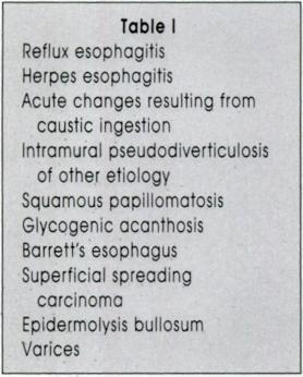 Figure 16 Reflux esophgitis This double contrst esophgognm demonstrtes n irregulr mucosl pttern