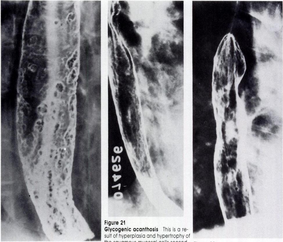 ndid esophgitis Roberts et l. I 4-4- 4- Figure 2 Squmous ppillomtosis This double contrst esophgognm demonstrtes diffuse cobblestone pttern. (ourtesy of Hrvey M. Goldstein, M.D.