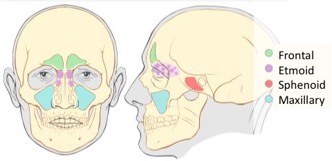 Figure 10. The paranasal sinuses. The nasal bones form the bridge of the nose. The ethmoid bone and the inferior nasal conchae bone form the three paired conchae or bumps in the nasal cavity.