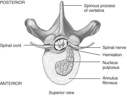 Protrusion of the nucleus pulposus Most commonly in lumbar region Pressure on spinal nerves causes pain Herniated (Slipped) Disc Clinical Problems Abnormal curves of the spine scoliosis (lateral
