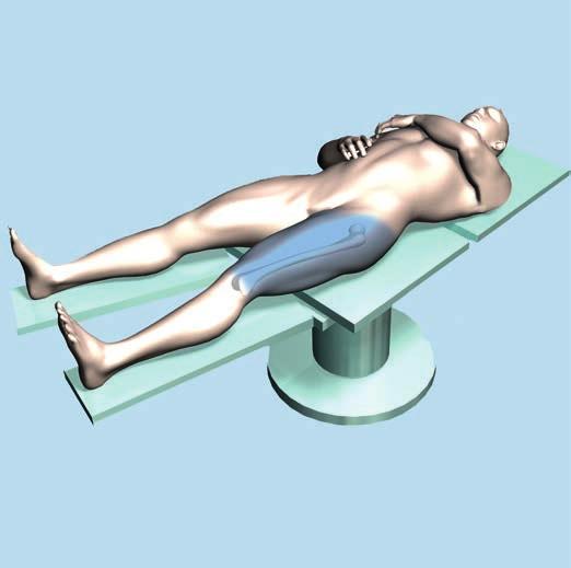 Open Femur 1 Position patient Position the patient supine on a fracture or radiolucent operating table.