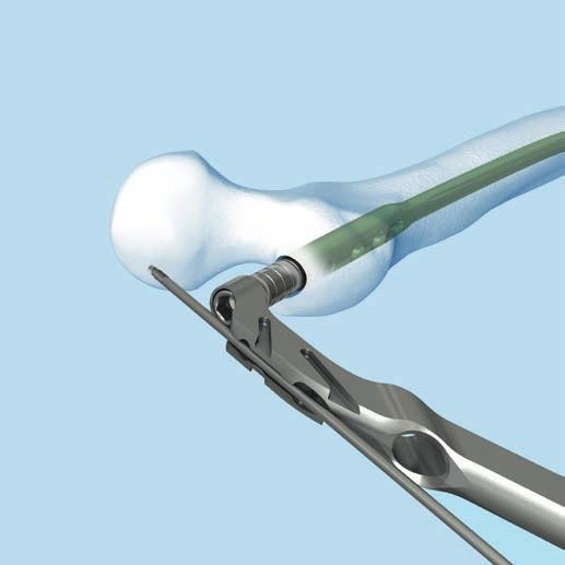 Proximal Locking Recon To ensure the correct anteversion of the implant, insert an additional guide wire into the groove on