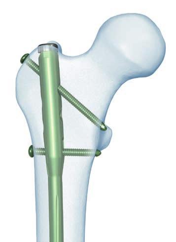 instrumentation Easy insertion and extraction Flattened lateral side reduces impingement of the lateral cortex and decreases