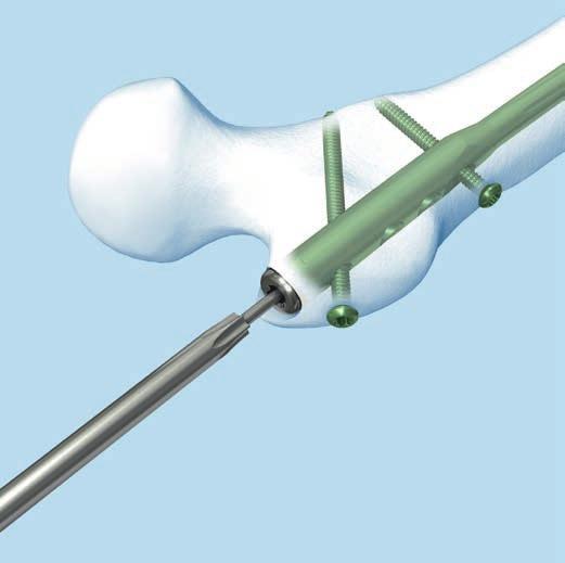 Implant Removal Implant removal is an optional procedure. 1 Remove end cap Instruments 03.010.110 Screwdriver Stardrive, T40, cannulated, length 300 mm 357.399 Guide Wire B 3.