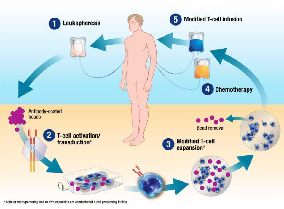 CTL019 Overview of CTL019 Manufacturing Leukapheresis: The patient s own T cells are harvested T cells are activated and genetically transduced ex vivo with a lentiviral vector encoding the anti-cd19