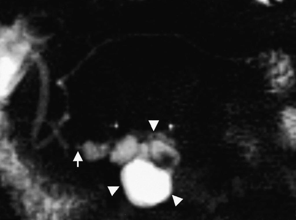 MR Cholangiopancreatography and MR Angiography in Benign and Malignant Intraductal Papillary Mucinous Tumors of Pancreas RESULTS The MRCP findings for intraductal papillary mucinous tumors are
