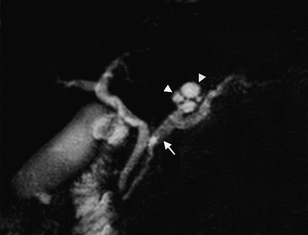 Among branch duct-type and combined-type benign IPMTs, 12 branch duct lesions (71%)were in the uncinate process and/or head, and five were in the body and/or tail.