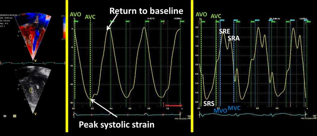 Myocardial Strain (ɛ) and Strain Rate (SR) Imaging Myocardial strain (ε) and strain rate (SR) imaging are measures of ventricular deformation (contraction in different dimensions).