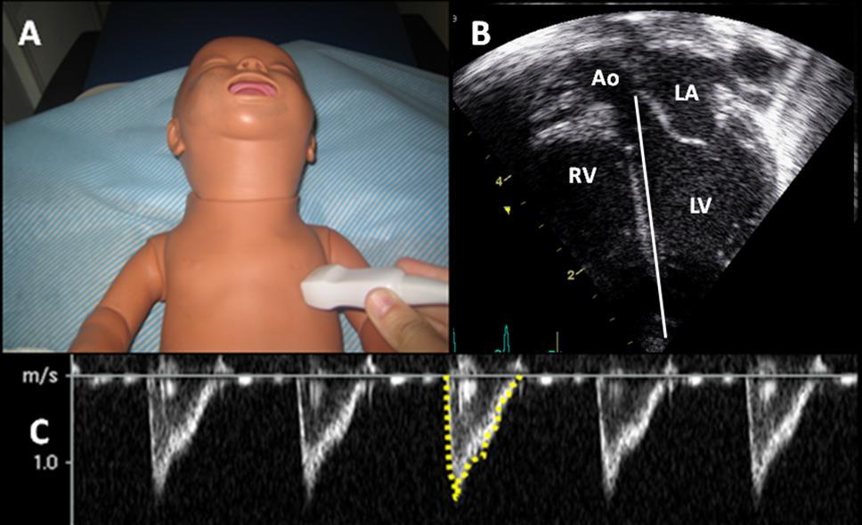 Evaluation of Left Ventricular Output Assessment of LVO involves measuring the mean velocity of blood flow across the ascending aorta from an apical five chamber view using pulsed wave Doppler and