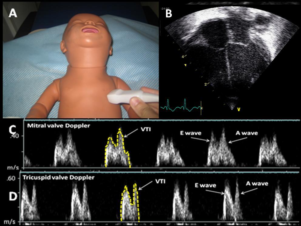 Diastolic Performance Diastolic performance of the heart can be assessed indirectly by examining the biphasic pattern of flow across the mitral valve known as trans-mitral flow.