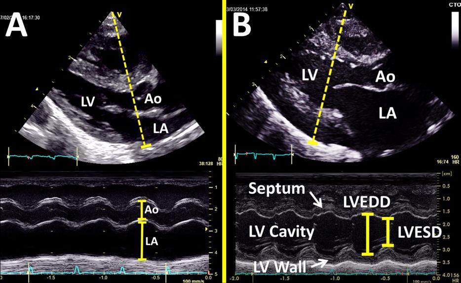 Markers of Pulmonary overcirculation Measurements Required: 1) Left atrial to aortic root ratio (LA:Ao) 2) Left ventricular end diastolic diameter (LVEDD) 3) Pulmonary vein peak systolic and