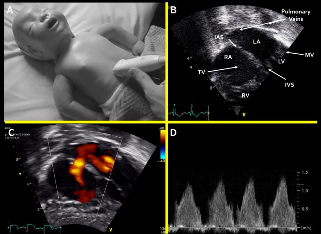 Assessment of the Intra-Atrial Shunt The subcostal view is usually left towards the end of the examination as it causes discomfort to the infant.