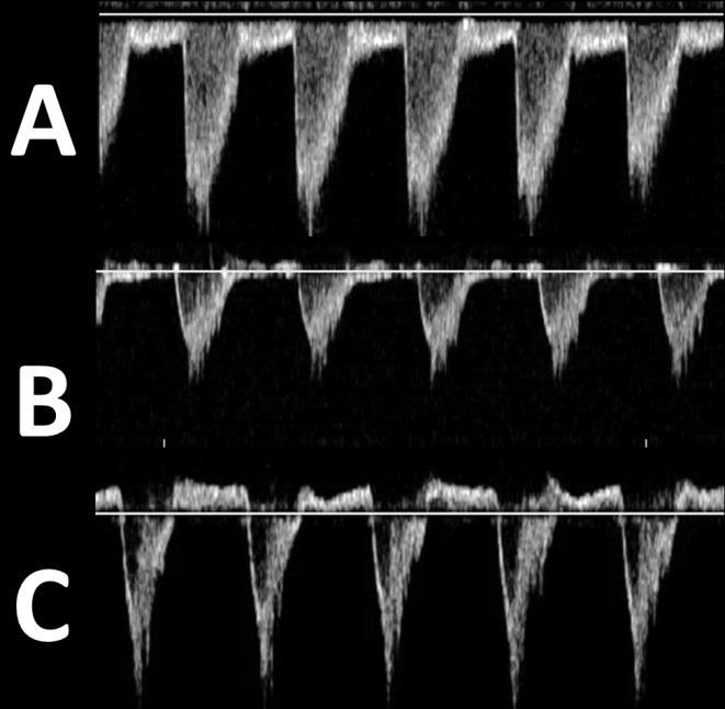 Panel (A) demonstrates forward flow in diastole in the absence of a PDA. Panel (B) demonstrates the presence of absent diastolic flow in the presence of a moderately significant PDA.