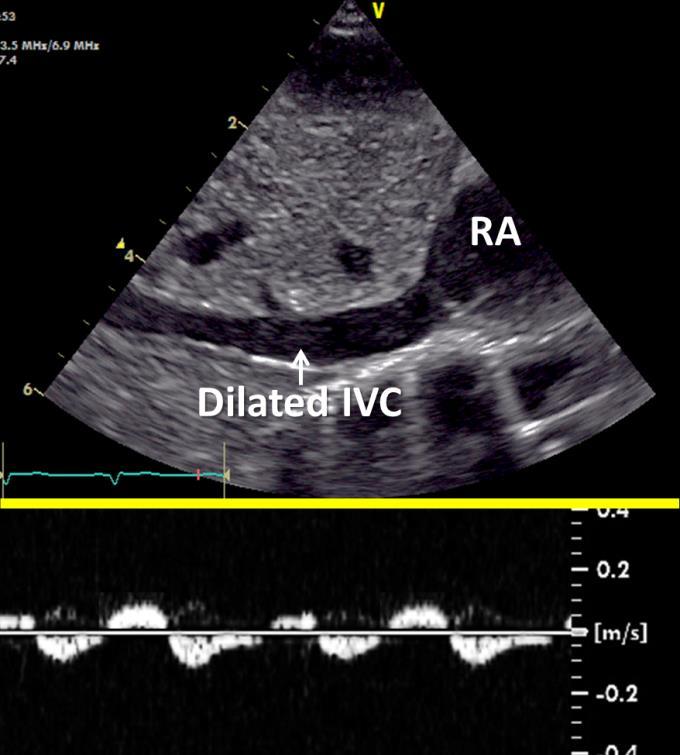 1) SUBCOSTAL VIEW Inferior Vena Cava View Inspection of the inferior vena cava in pulmonary hypertension (PH) can demonstrate a dilated vessel due to elevated RA pressures [Figure 5.1].