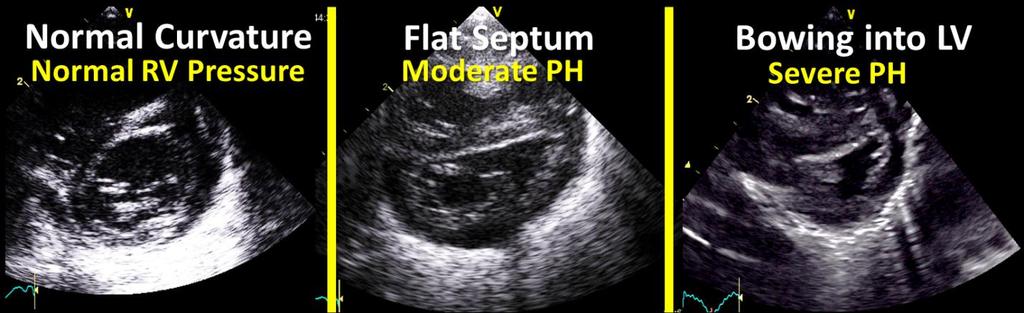 3) SHORT AXIS PARASTERNAL VIEW Examination of the septal wall motion during systole can provide a qualitative assessment of the degree of PH.