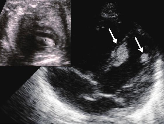 D echocardiography for neonatal cardiac tumors prognostic indicators, were not observed.