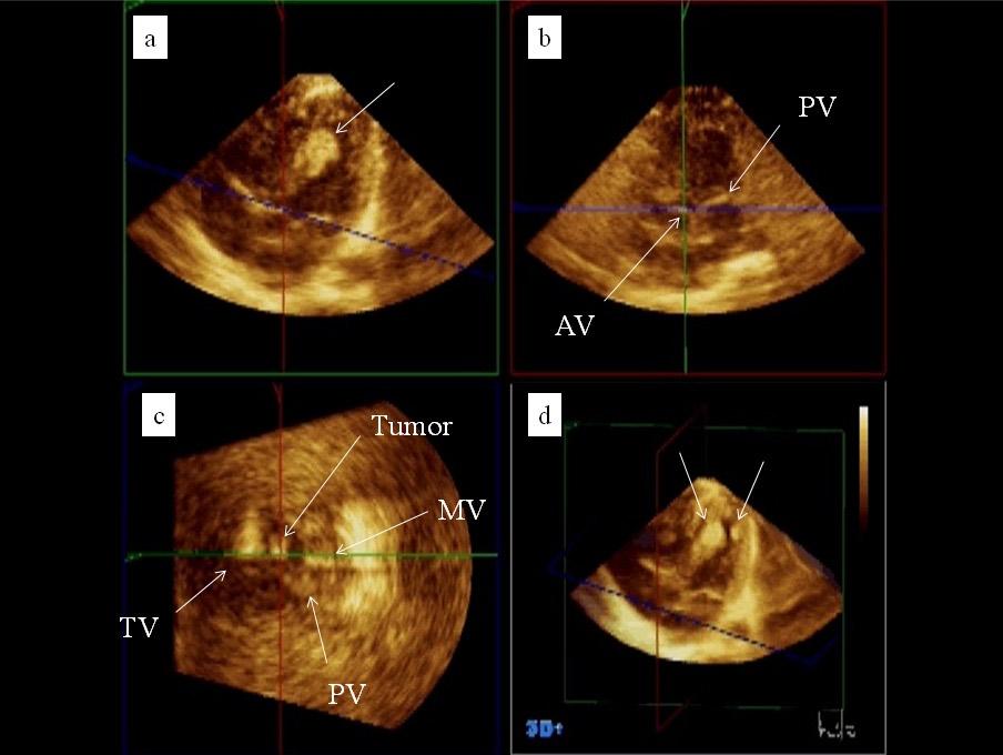 Jichi Medical University Journal Figure 2 Real-time three-dimensional echocardiographic findings of cardiac tumors during neonatal period.
