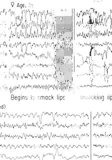 This increased in frequency and became bilateral as the patient developed impairment of consciousness. ~ eyes blinking headto righl FIG. 3.