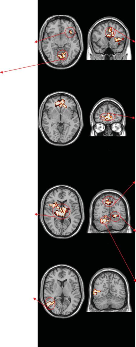 Functional neuroanatomy of blood-injection-injury phobia 5 (a) Images of Spiders 0.15 0.05 phobics phobics z = 9 y = 16 0.15 0.05 0.
