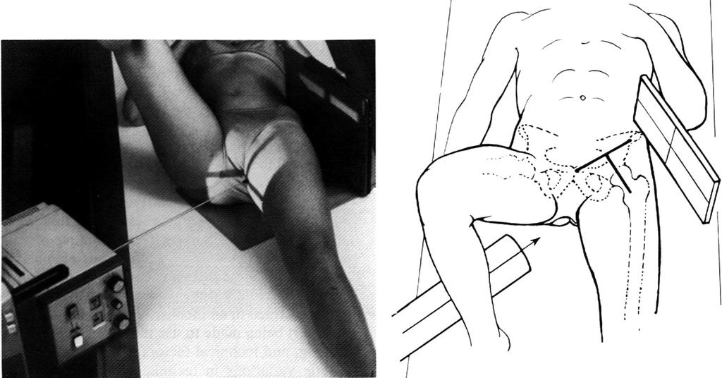 True-lateral (Johnson or cross-table) lateral view. (A) Position of patient.