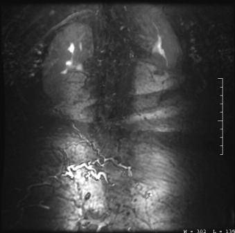 A B Figure 17 A-B. (A) An unsubtracted image in the coronal plane of the posterior lumbar region following contrast injection to visualize a suspected arteriovenous malformation (AVM).
