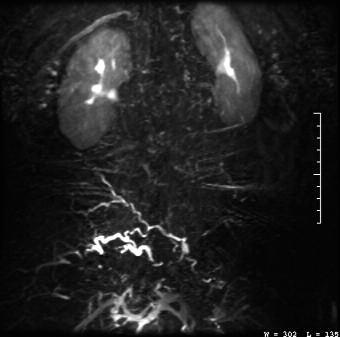 Note the greatly increased visualization of the AVM in the subtracted image. Courtesy of Thomas Schrack, BS, ARMRIT, Fairfax Radiological Consultants, Fairfax, VA.