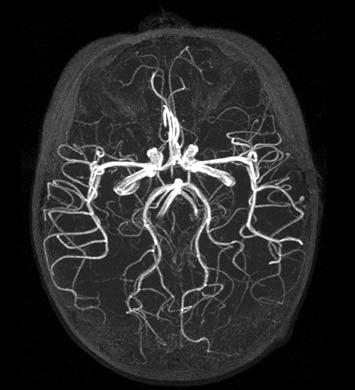 MR ANGIOGRAPHY OF THE BRAIN AND NECK MR angiography has become a mainstay of brain imaging.