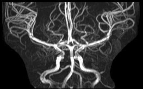 Intracranial MR angiography projections of a noncontrast enhanced 3D TOF multislab acquisition. (A) Axial collapsed MIP. (B) Coronal MIP.