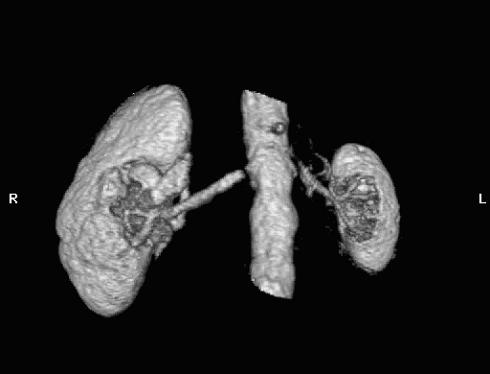 Figure 32. Volume rendered 3D MRA image illustrating bilateral proximal renal artery stenoses. Courtesy of F. Scott Pereles, MD, Northwestern Memorial Hospital.