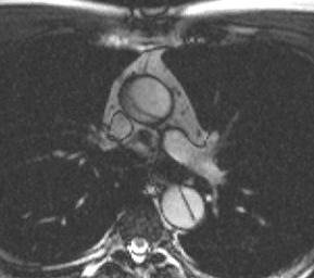 Normal aorta, left anterior oblique the contrast injection run.