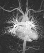 Figure 39. Single subtracted MIP image from subsecond MR angiography showing a pulmonary AVM in the right lower lobe (arrow). Images courtesy of F. Scott Pereles, MD, Northwestern Memorial Hospital.