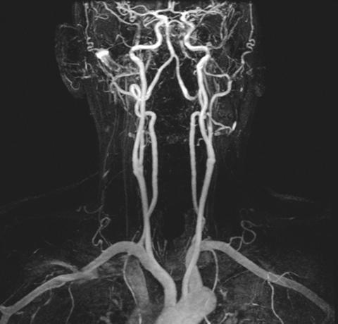 Include basilar and vertebral arteries through carotid siphon Slice Thickness: 1.