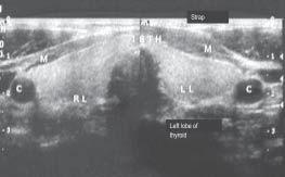 FIG. 1a. Normal thyroid lobe echogenicity. FIG. 1b. Hypoechogenic thyroid lobes consistent with thyroid autoimmunity. FNAC or TPO Ab positivity was 47% and 51.4% respectively.
