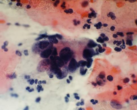 Case histories No cytology record in UK (excluding tests within 6 months of diagnosis) Woman aged 25 Symptomatic adenocarcinoma (stage IB1) presented with post-coital