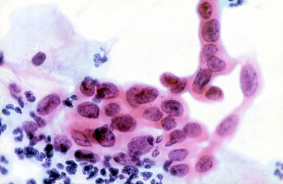 Case histories Negative cytology >5 years before diagnosis) Woman aged 28 (medico-legal case) Routine cytology: severe dyskaryosis (HSIL favor CIN3) Screen-detected adenocarcinoma (stage IB1) treated
