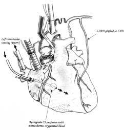 J Heart Valve Dis Beating-heart aortic valve replacement 237 Figure 1: Beating heart aortic valve replacement using retrograde coronary sinus (CS) perfusion with oxygenated normothermic blood.