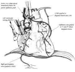 sequentially to the diagonal and left anterior descending (LAD) arteries, a patent in-situ RGEA grafted to the posterior descending artery, and a patent saphenous vein grafted to the 1st and 2nd