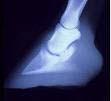 RADIOGRAPHIC VIEW What is the difference between Laminitis and Founder?