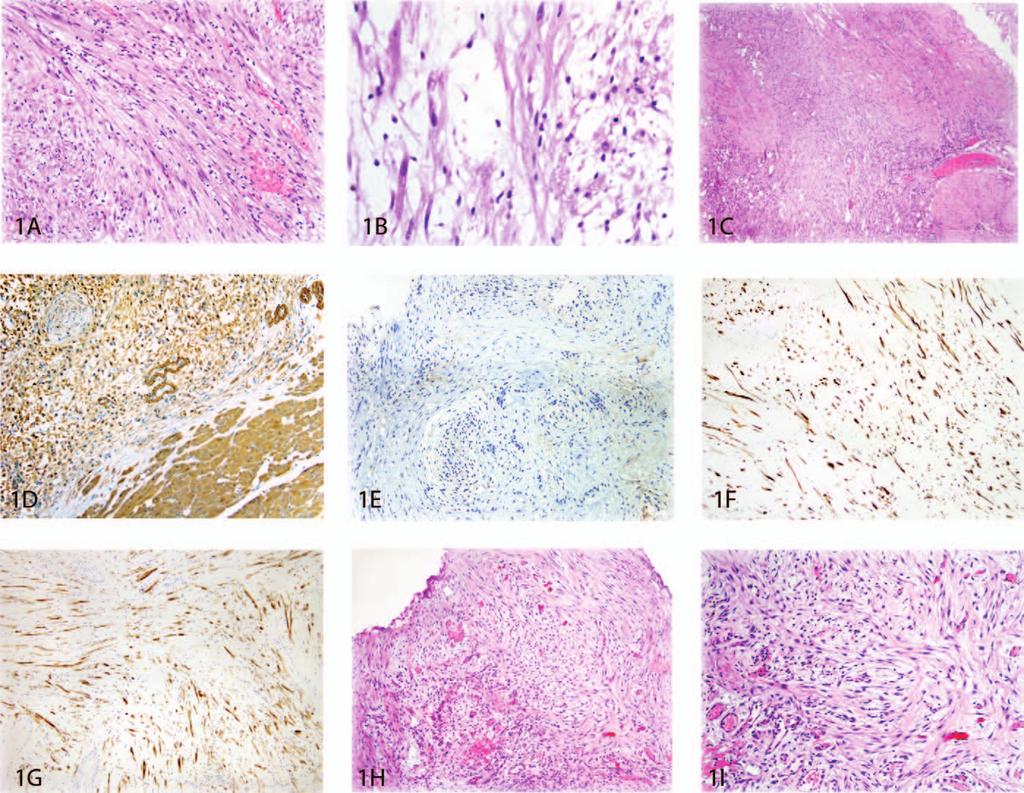 Figure 1. A, Inflammatory myofibroblastic tumor typically shows a loose, fascicular architecture with tapered myofibroblasts and lightly eosinophilic elongated cytoplasmic processes.