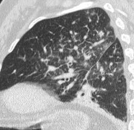 prevailing MOST COMMON PRIMARIES: Adenocarcinoma (80%): breast, gastric, pancreatic 81-year-old male